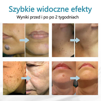 ✨ Bikenda®  – Laserowy Długopis CO₂ do Usuwania 🟤 Znamion, 🦠 Brodawek, 🔘 Przebarwień i Innych Niedoskonałości Skóry