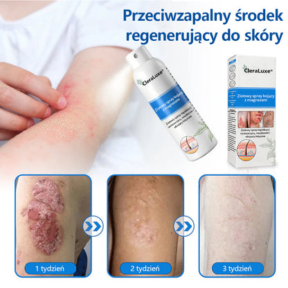 Oficjalny sklep✅: CleraLuxe®Magnezowy spray ziołowy na łuszczycę📦