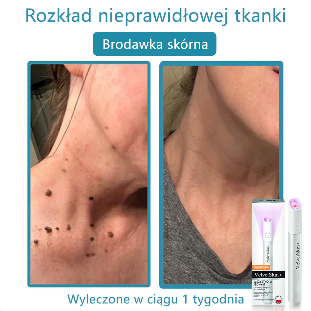 ✨ Bikenda®  – Laserowy Długopis CO₂ do Usuwania 🟤 Znamion, 🦠 Brodawek, 🔘 Przebarwień i Innych Niedoskonałości Skóry